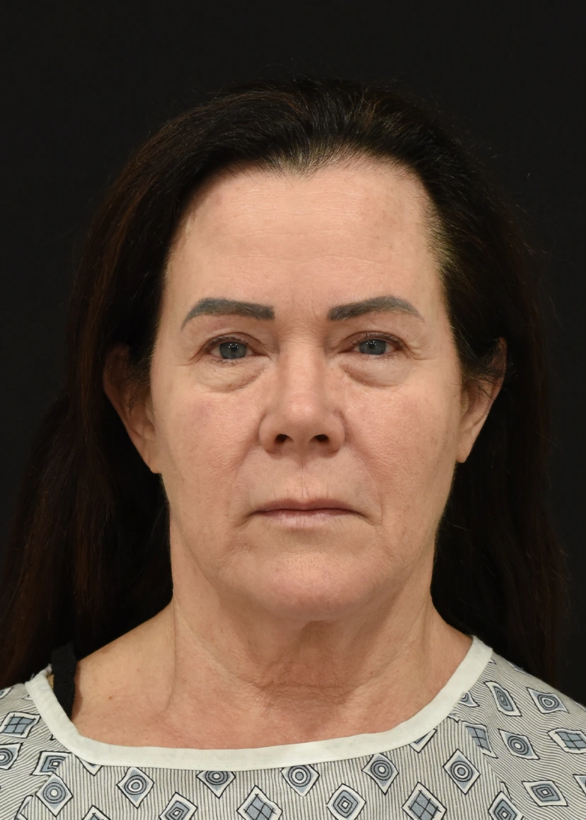 Deep Plane Facelift Patient 26 Set 1 Before