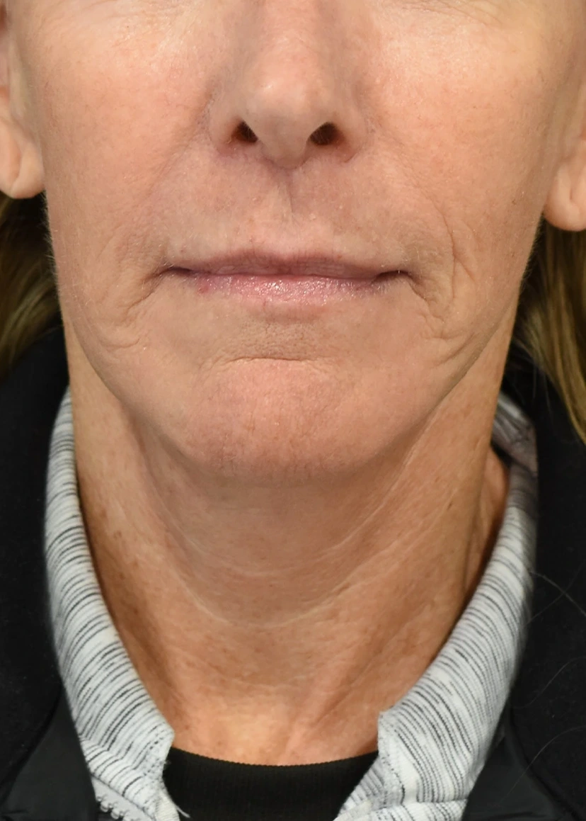 Deep Plane Facelift Patient 31 Set 1 Before